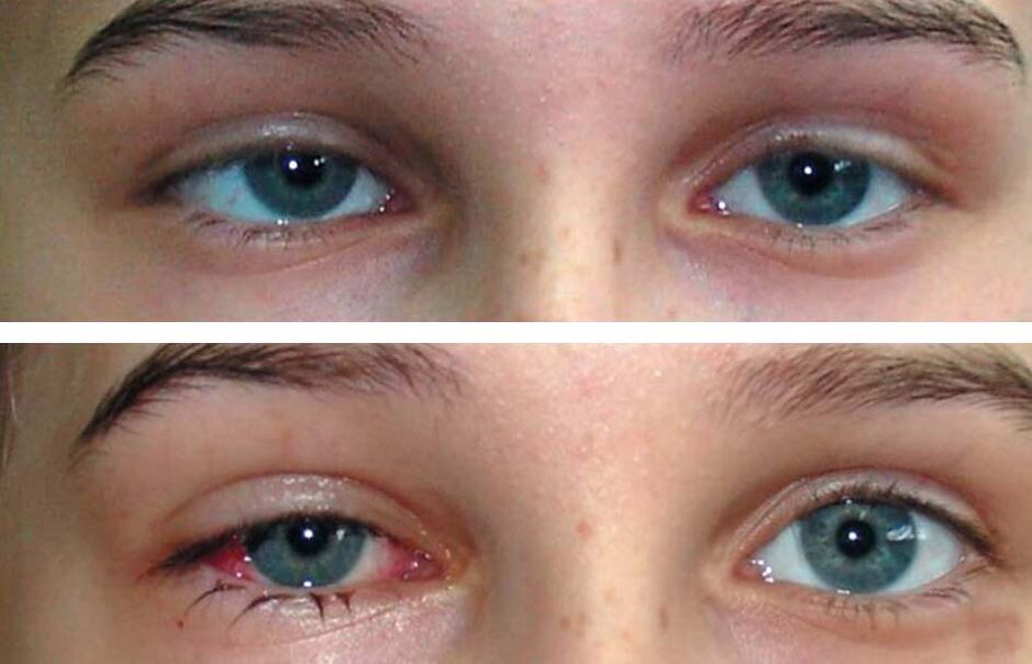 Before and after Oculax treatment