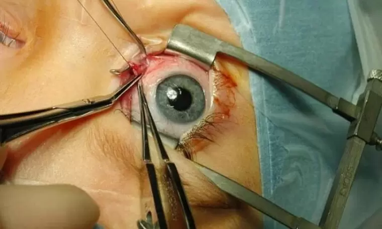 Perform eye surgery using an eyelid speculum